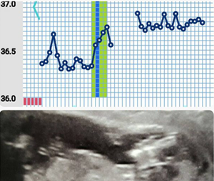 PCOS - kiss my A**! I'm pregnant with OvuSense baby number 2!