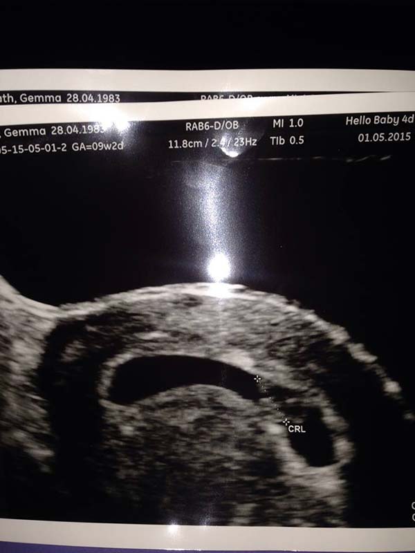 Gemma's baby scan