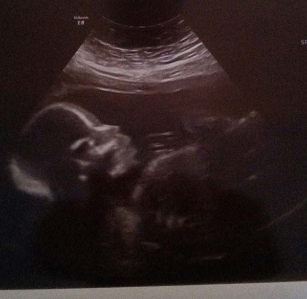 Suzanne's 21 week baby scan